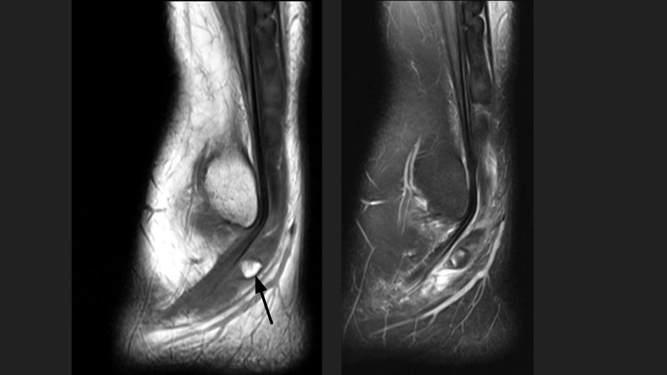 Figure 3 for case Charcot joint ( RID5075 )